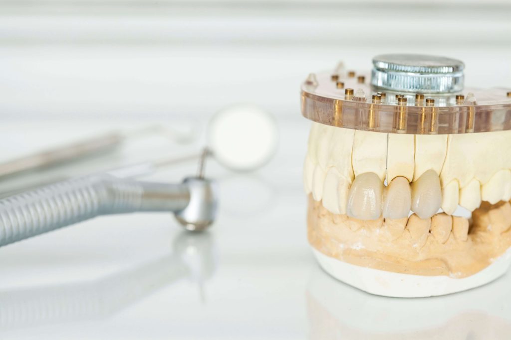 implanturi dentare