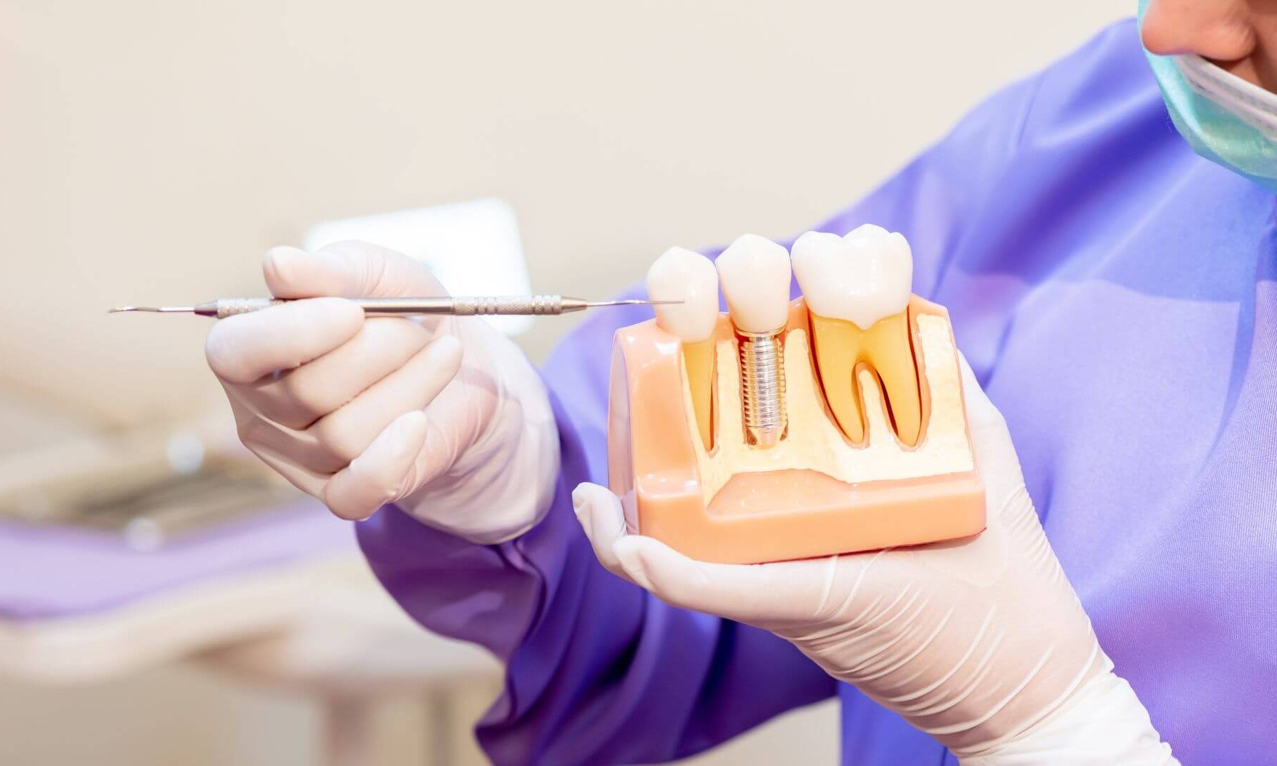 implent dentar zirconiu vs titan