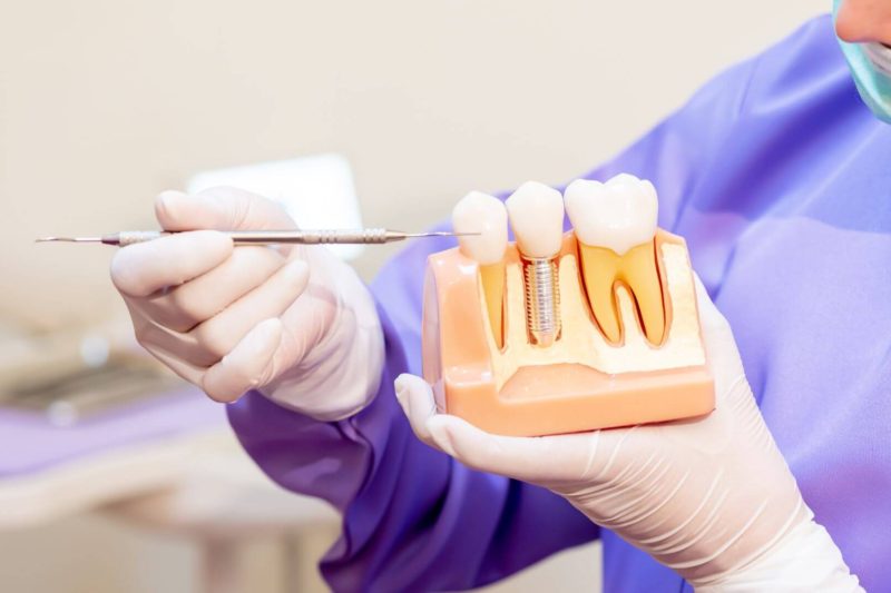 implent dentar zirconiu vs titan