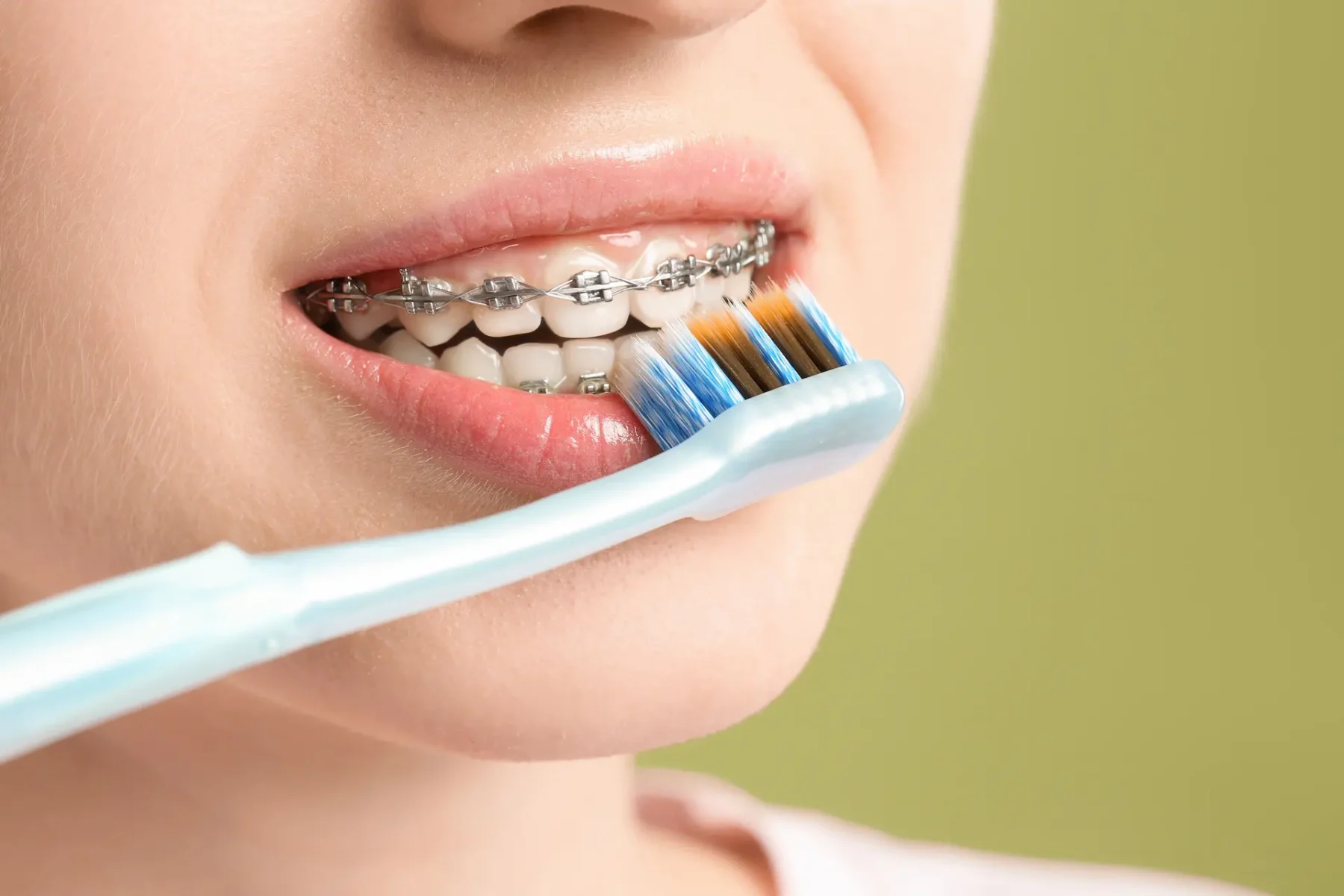 ingrijire aparat dentar copii
