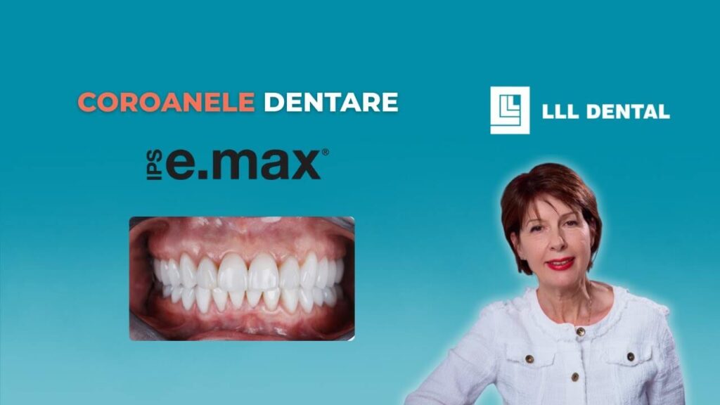 Vezi când recomandăm coroanele dentare Emax la Clinica LLL Dental