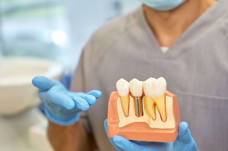 la cat timp dupa extractie poti face implant dentar