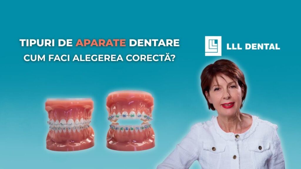 Vezi cum alegi tipul de aparat dentar la Clinica LLL Dental