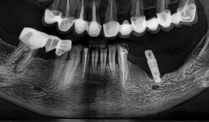 Respingerea implantului dentar. Pacient care a solicitat indepartarea implantului dentar pus in alt cabinet datorita durerii.