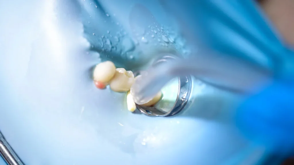 Pregătirea dintelui