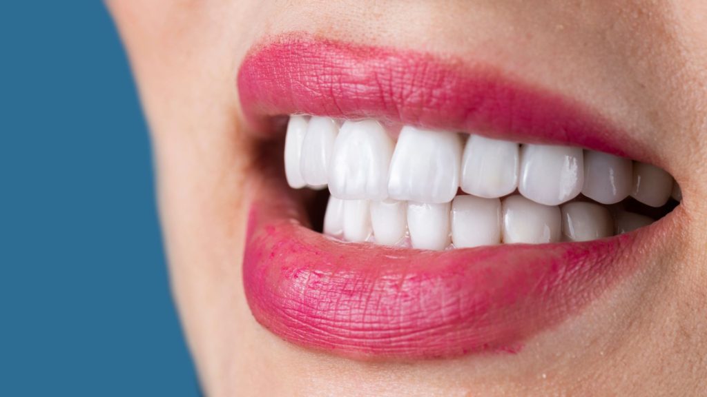 pretul fatetelor dentare pentru toata gura