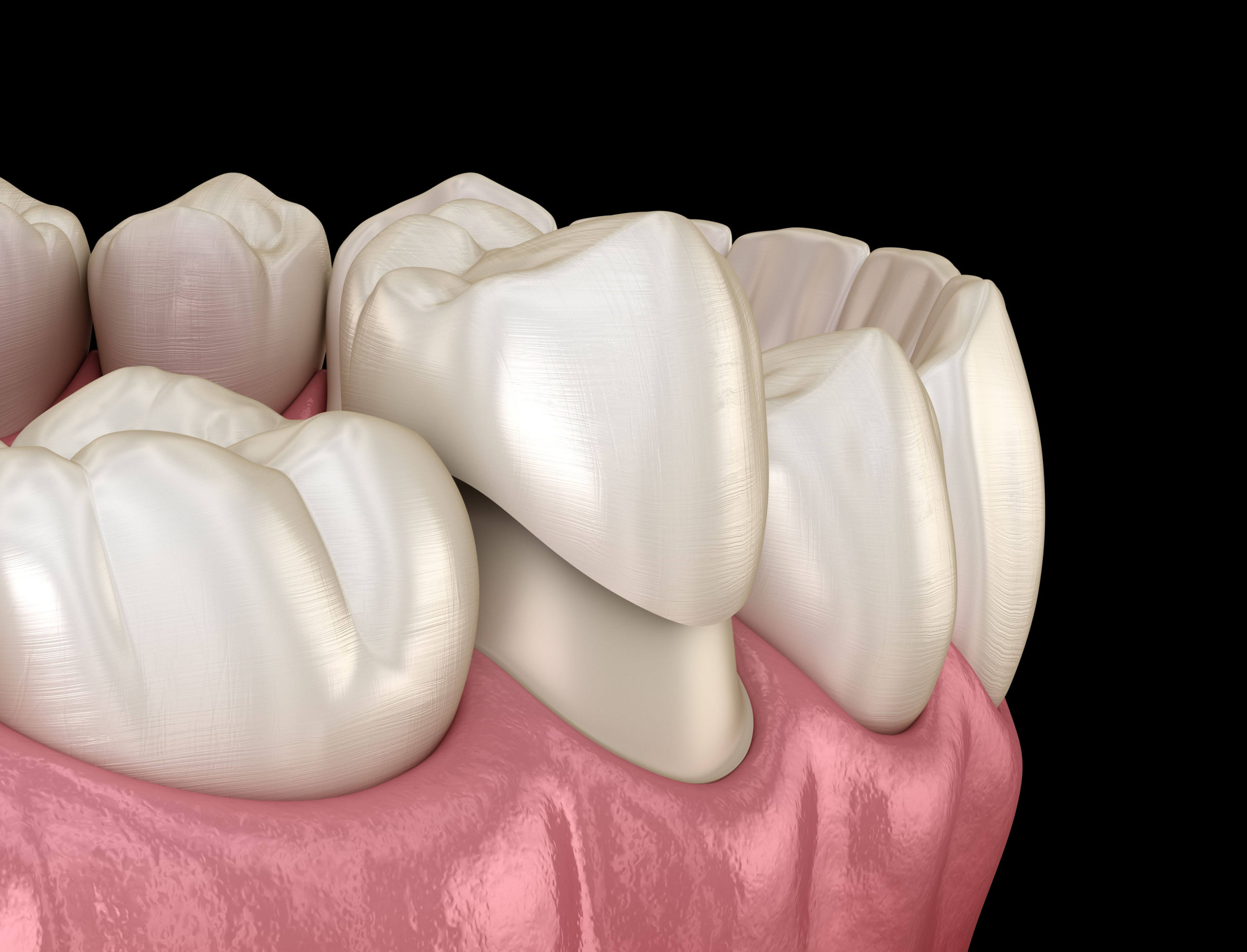 Care sunt etapele aplicarii coroanelor dentare din zirconiu?