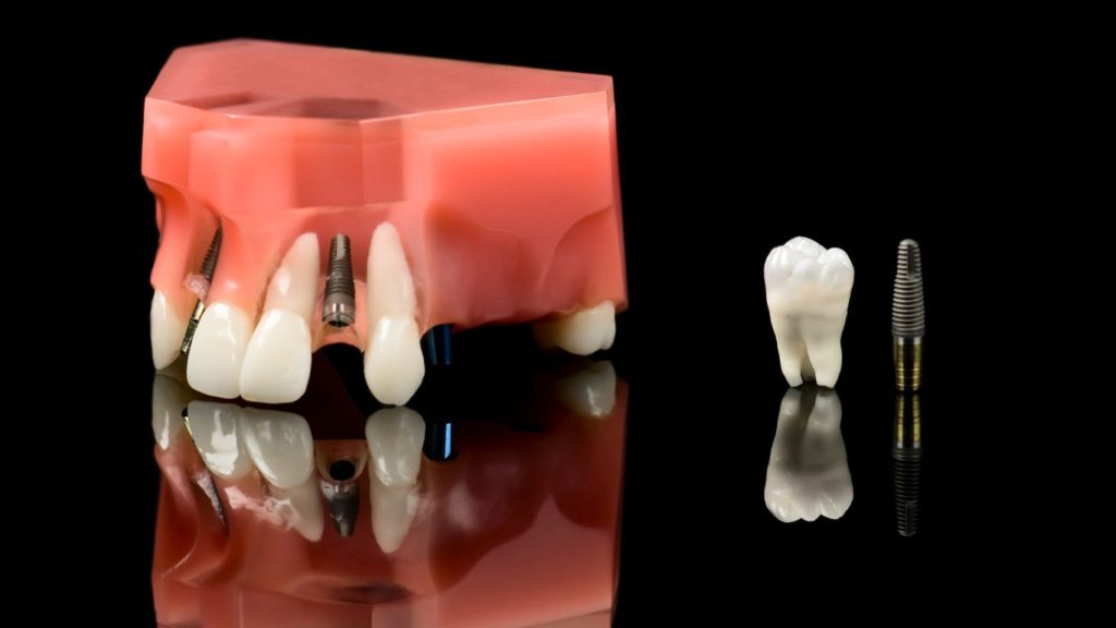 procedura descoperire implant dentar