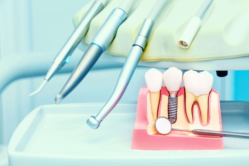 procedura implant dentar