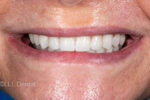 După: reabilitare totală cu dinți ficși pe implanturi (All-on-8 sus, All-on-6 jos) la LLL Dental