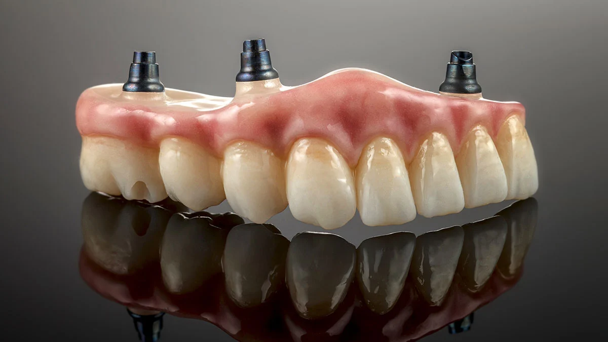 Variante de tratament cu implanturi pentru refacerea întregii danturi