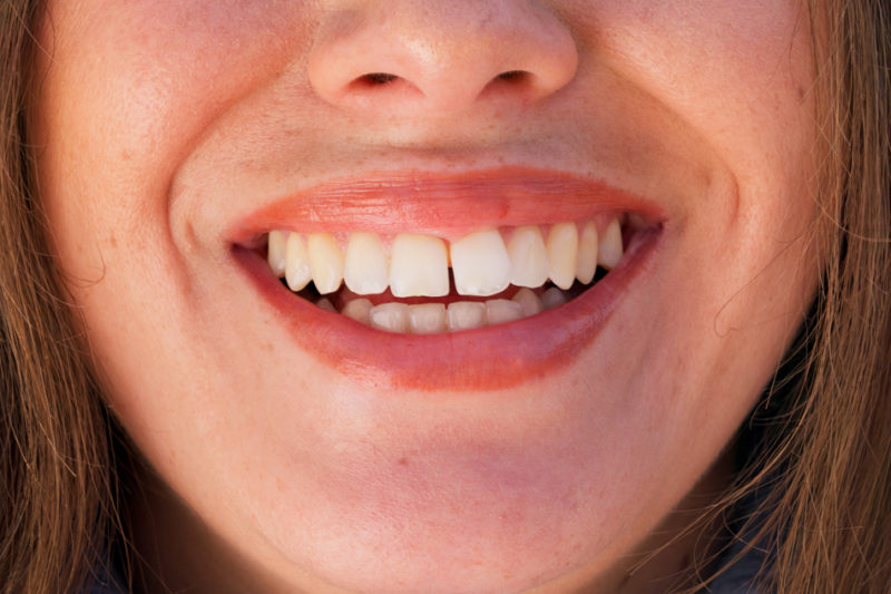 diastema