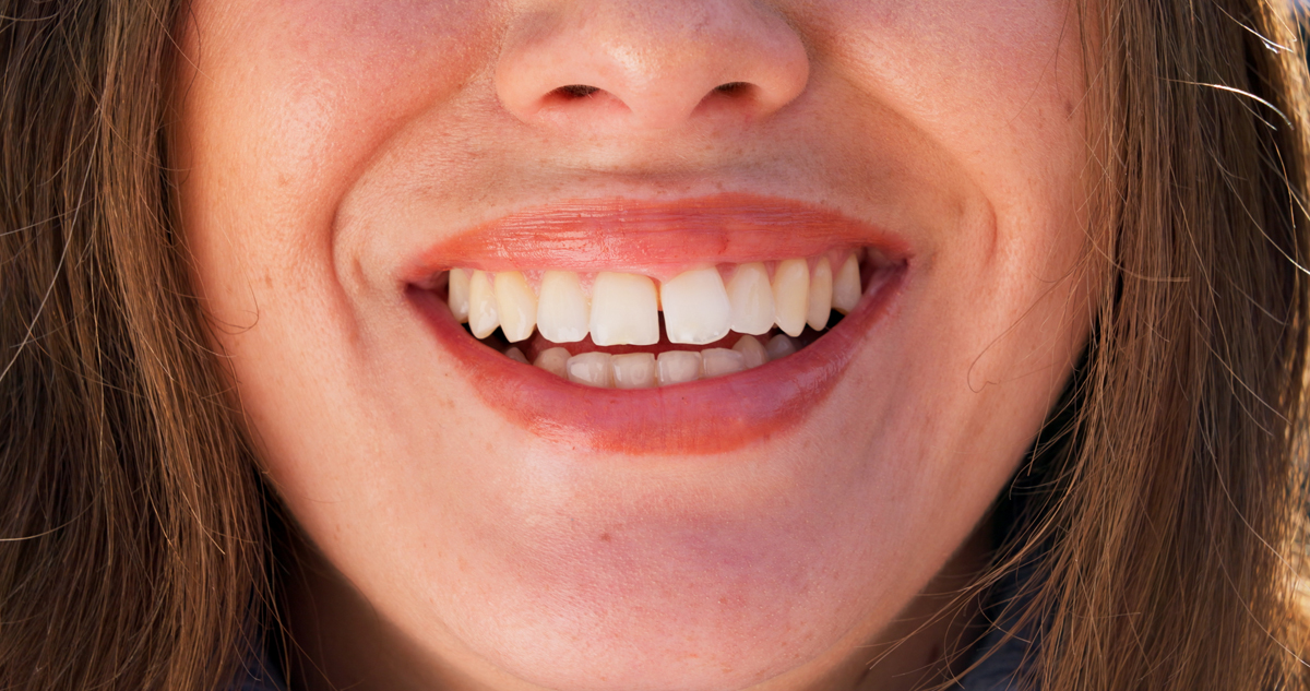 diastema