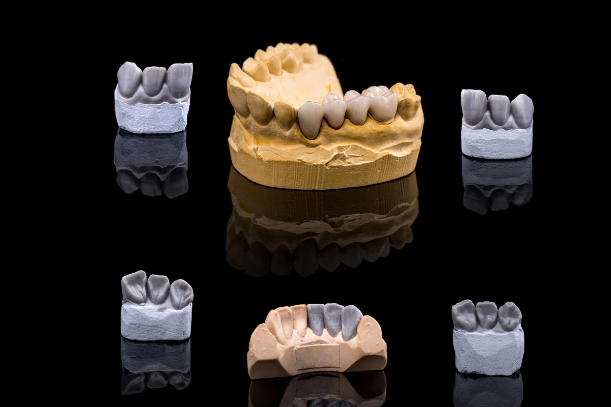 Când este indicat tratamentul cu coroană dentară?