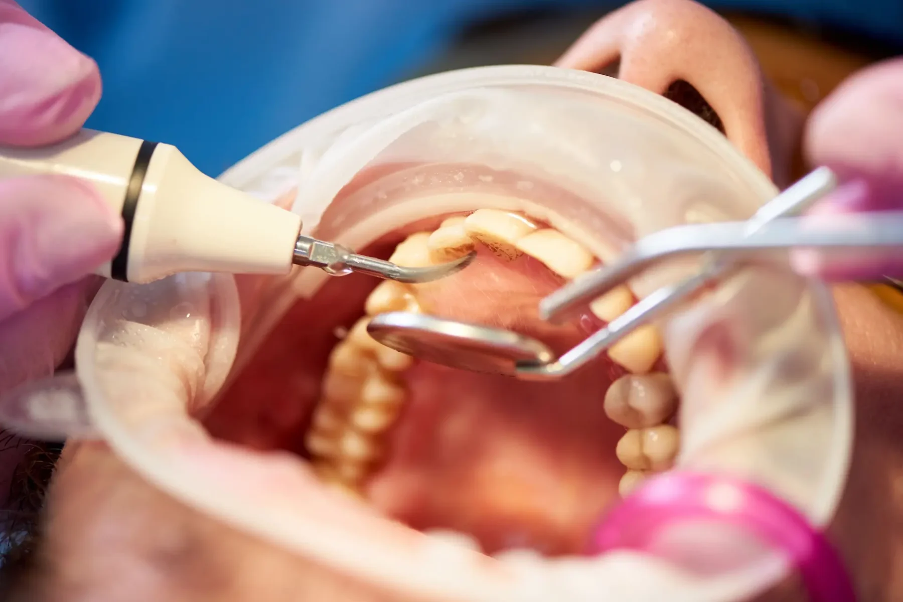 tratament parodontoza llldental