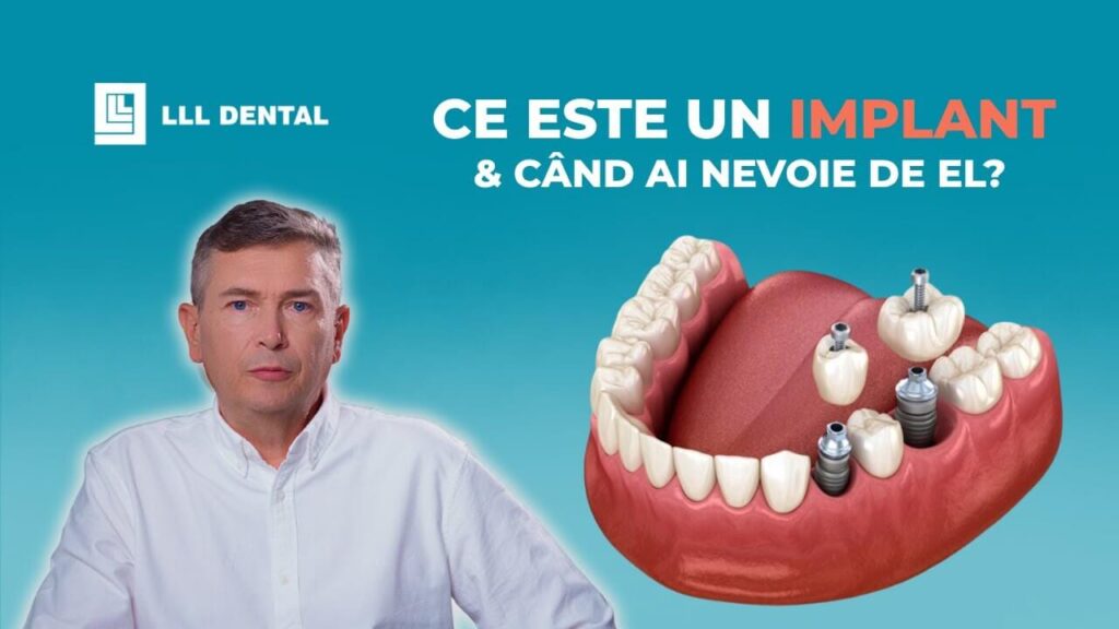 Vezi cum realizăm tratamentul cu implant dentar la Clinica LLL Dental
