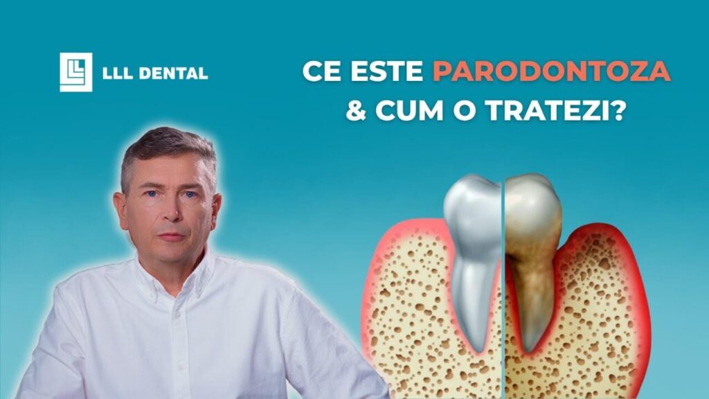 Vezi cum tratăm parodontoza la Clinica LLL Dental