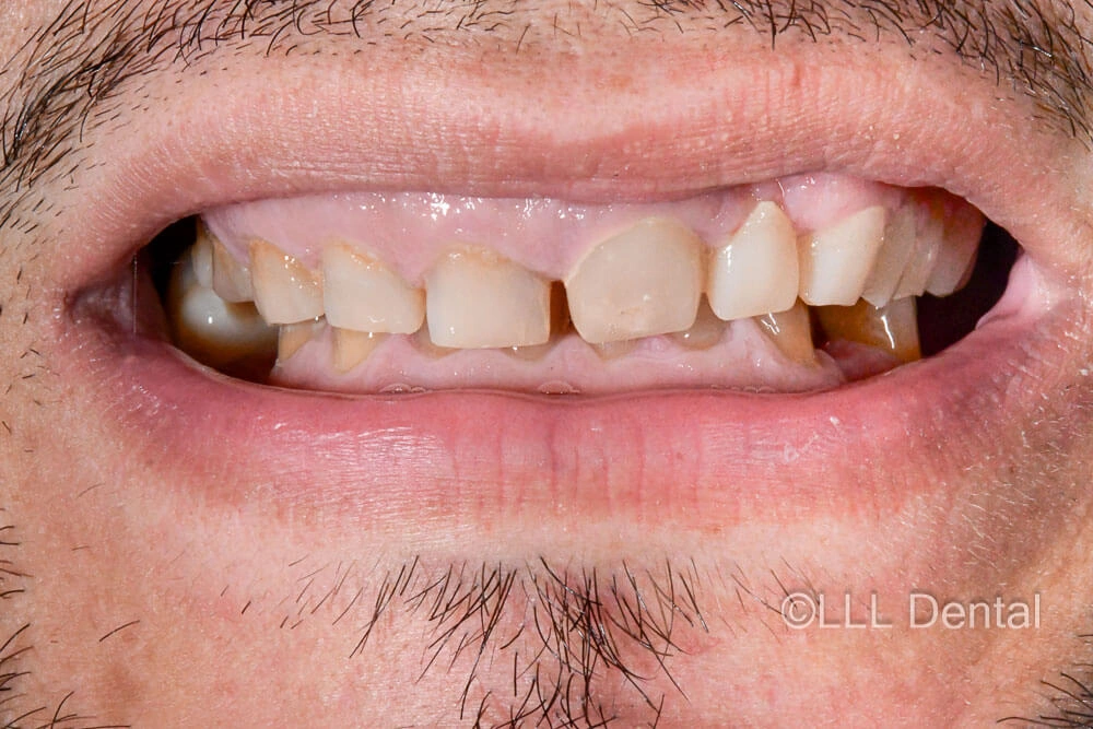 fatete-zirconiu-before