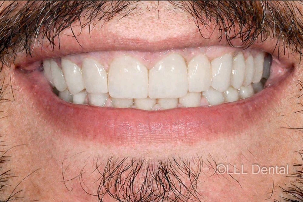 fatete-zirconiu-after