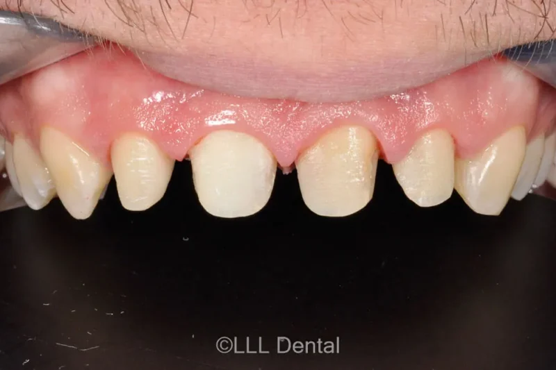 dinti piliti inainte de fatete dentare
