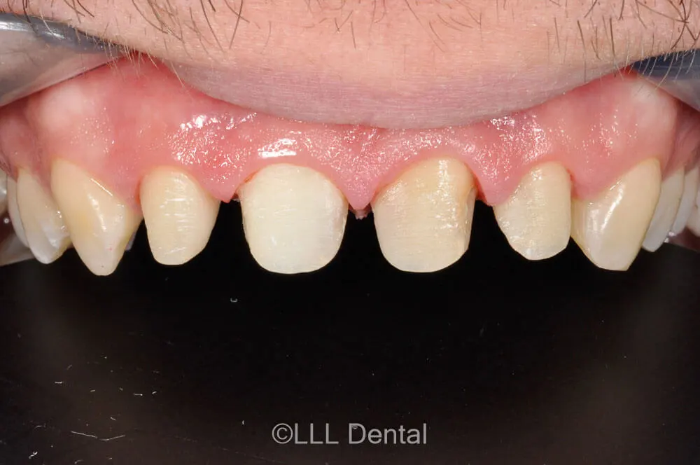 fatete zirconiu before