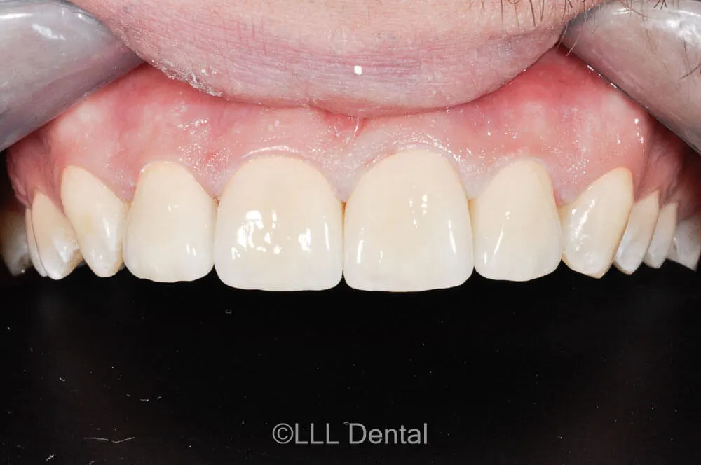 fatete zirconiu after